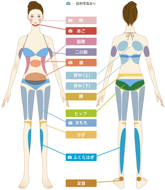 頬、あご、脇腹、二の腕、腹、背中（上）、背中（下）、腰、ヒップ、太もも、膝、ふくらはぎ、足首。　頬、あご、腹、太もも、ふくらはぎは症例写真あり。