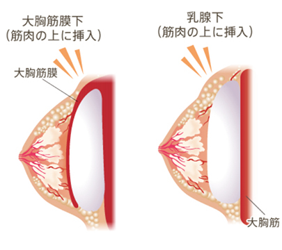 大胸筋膜下（筋肉の上に挿入）、乳腺下（筋肉の上に挿入）