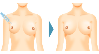 バッグ挿入後の左右差も、ハイブリッド豊胸術(コンポジット豊胸術)で修正が可能