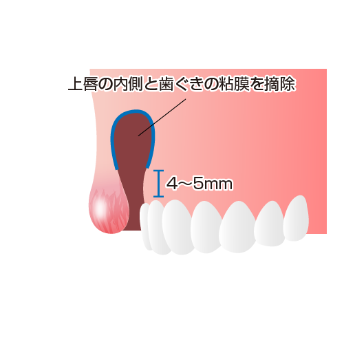 上唇の内側と歯ぐきの粘膜を摘除