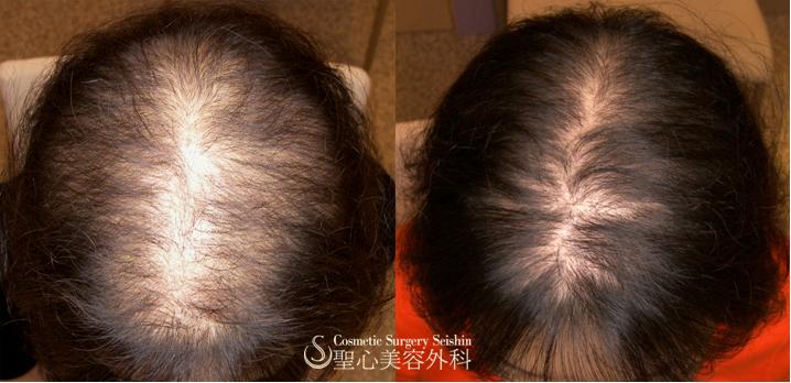 【40代女性：薄毛】グロースファクター再生療法（札幌院） After 
