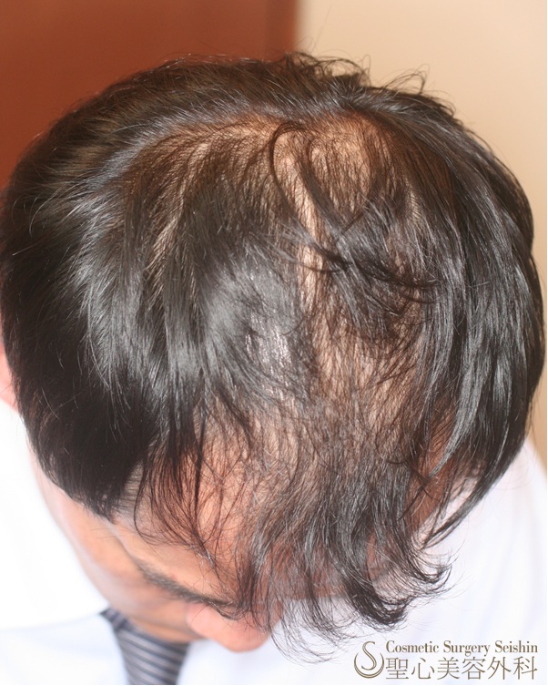 【30代男性：頭頂部の薄毛】グロースファクター再生療法+プロペシア+ロノテン+リアップX5 Before 