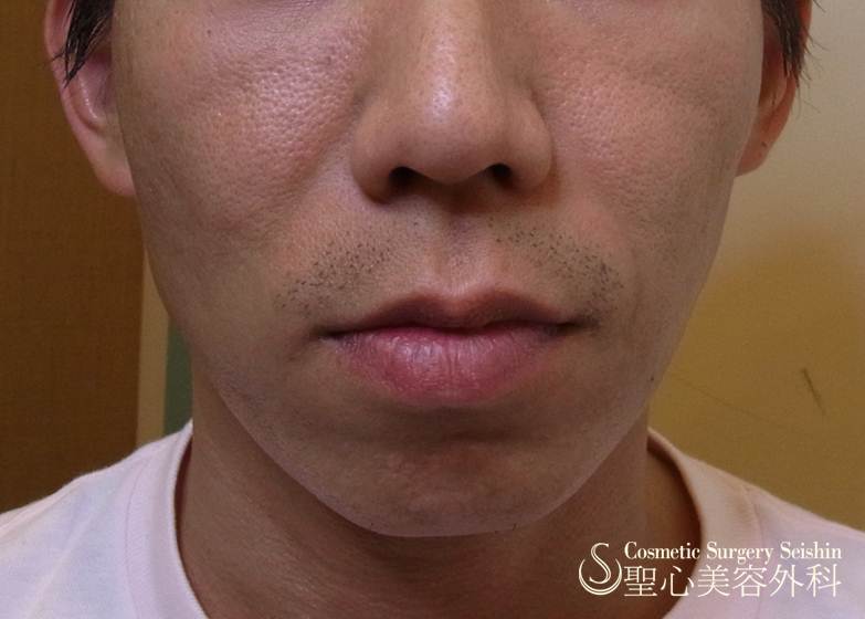 【30代男性：顔痩せ・こけ①】プレミアムPRP皮膚再生療法 Before 