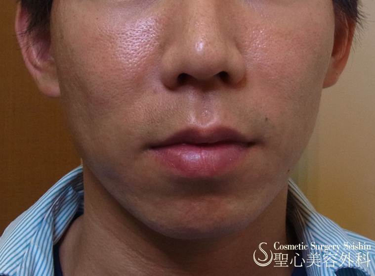 【30代男性：顔痩せ・こけ①】プレミアムPRP皮膚再生療法 After 