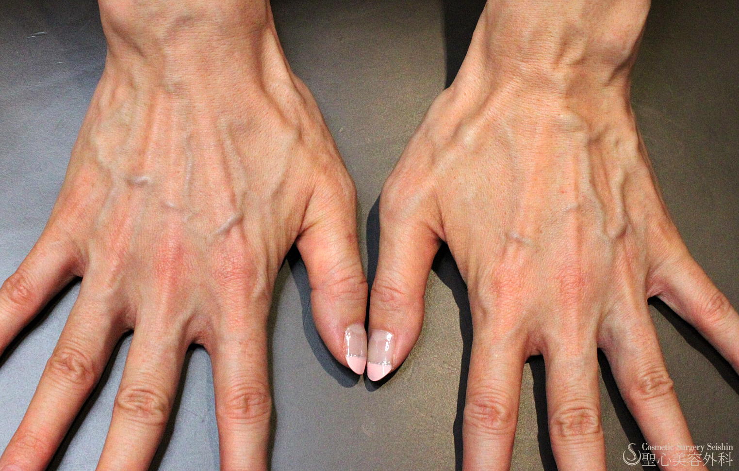 【40代女性・別次元の手の甲の若返り】プレミアムPRP皮膚再生療法（11年後） Before 