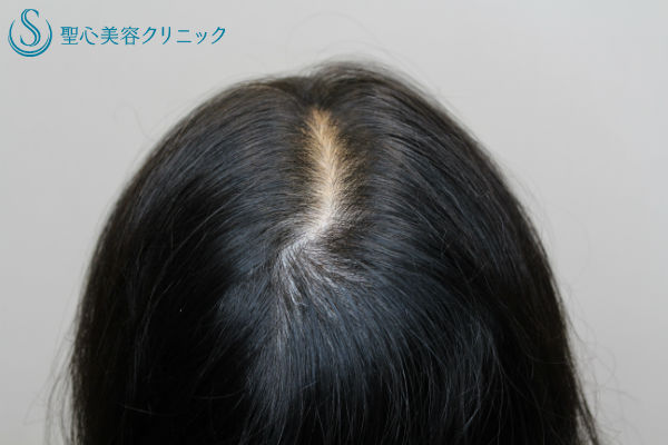 【40代女性・薄毛】グロースファクター再生療法、KIPスカルプへエッセンス、パントガール Before 