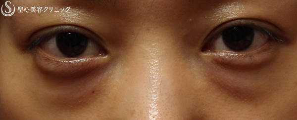 【30代女性・目元の若々しさ持続】プレミアムPRP皮膚再生療法（4年後） Before 