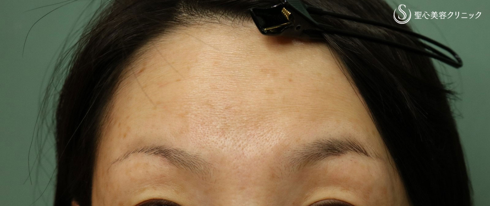 【30代女性・額のしわを改善】プレミアムPRP皮膚再生療法（5ヶ月後） After 