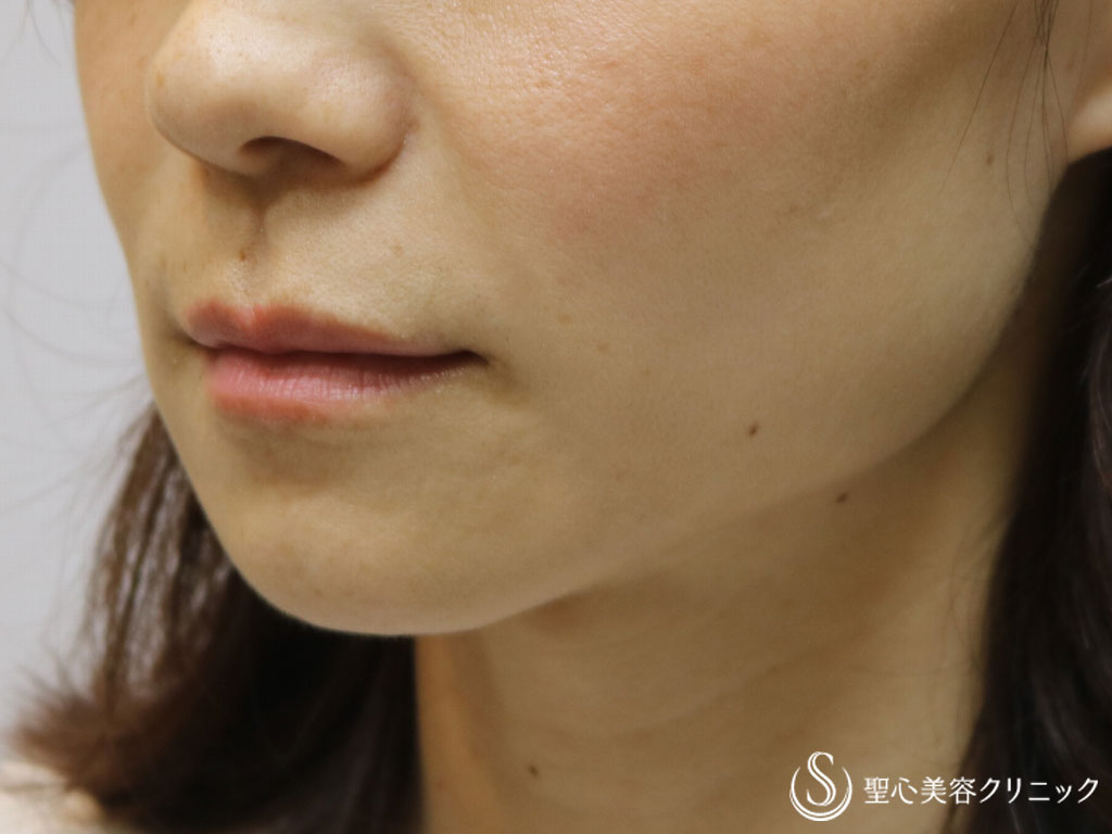 【30代女性・頬の凹みをなくし疲れた印象を改善】頬のヒアルロン酸注入（直後） Before 