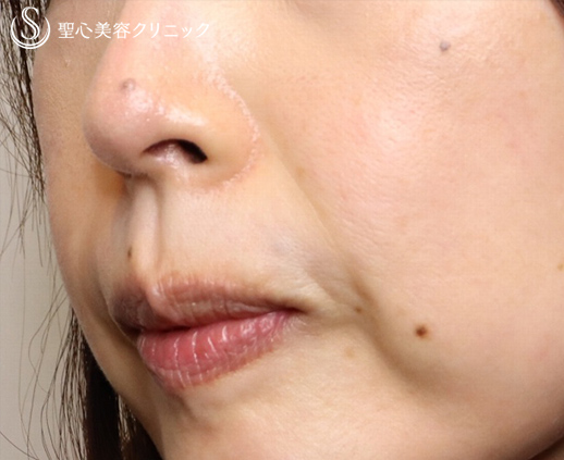 【40代女性・ほうれい線】プレミアムPRP皮膚再生療法（4ヶ月・6ヶ月） After 