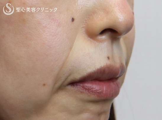 【40代女性・ほうれい線】プレミアムPRP皮膚再生療法（4ヶ月・6ヶ月） Before 