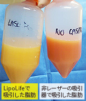 LipoLifeで吸引した脂肪：マンゴーファット。非レーザーの吸引器で吸引した脂肪。