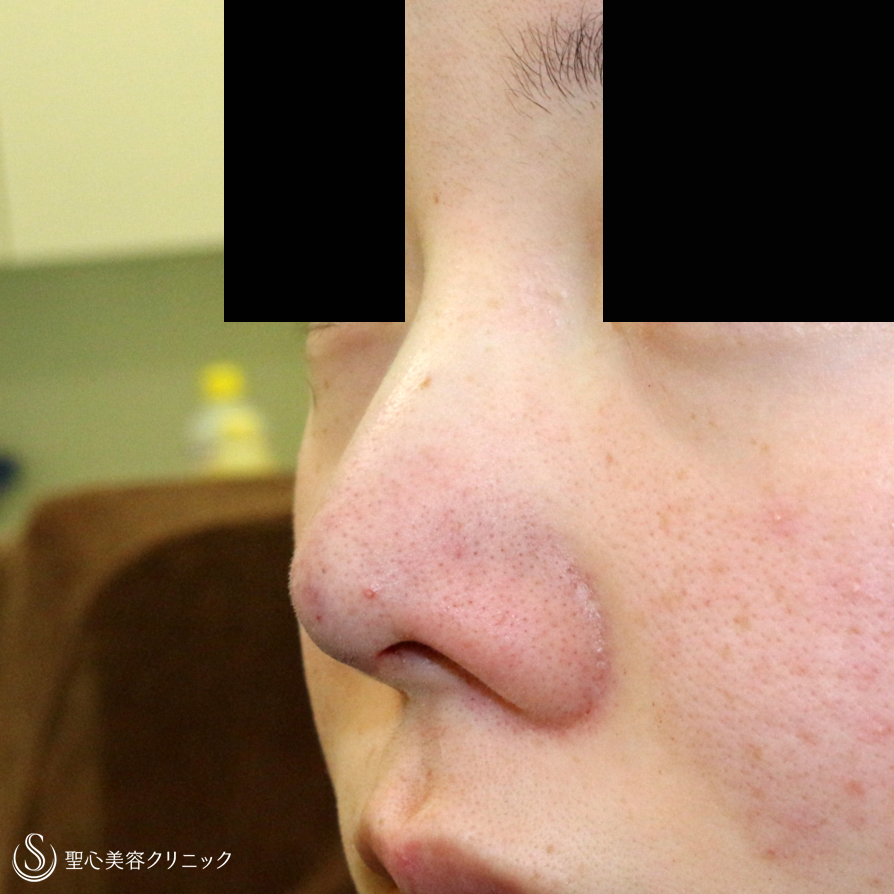 【20代女性・画期的なダンゴ鼻の治療＆鼻尖延長】3D鼻尖用・PCLドーム（1年4ヶ月後） Before 