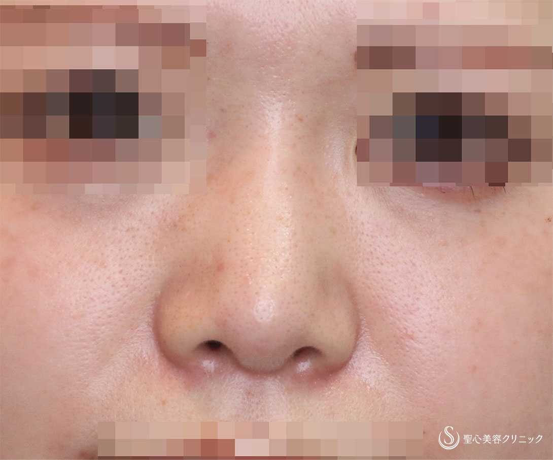 【20代女性・鼻筋と鼻先を美しく】Gメッシュ＋鼻先縮小＋耳介軟骨移植（3ヶ月後） After 
