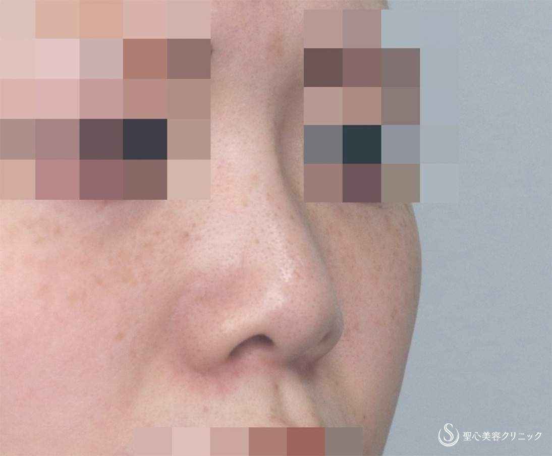 【20代女性・鼻筋と鼻先を美しく】Gメッシュ＋鼻先縮小＋耳介軟骨移植（3ヶ月後） Before 