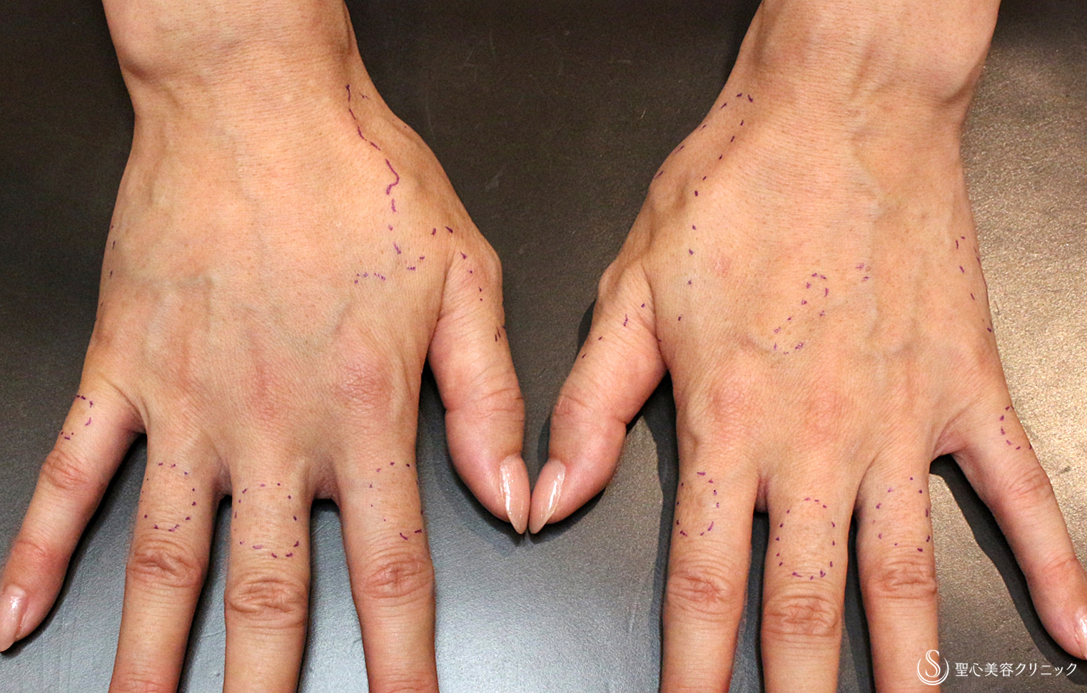 【40代女性・別次元の手の甲の若返り】プレミアムPRP皮膚再生療法（11年後） Before 