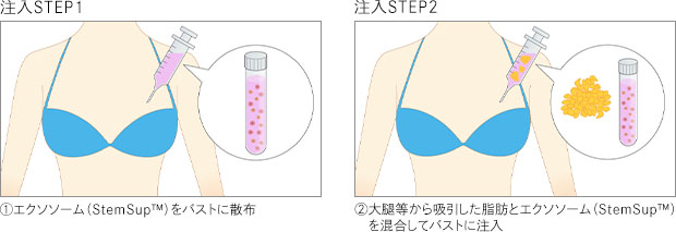 注入STEP1：エクソソーム(StemSup™)をバストに散布　注入STEP2：太腿等から吸引した脂肪とエクソソーム(StemSup™)を混合してバストに注入