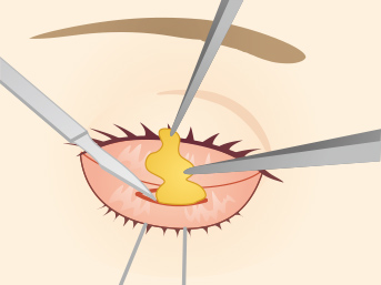 目の下の脂肪取り（経結膜下脱脂法）