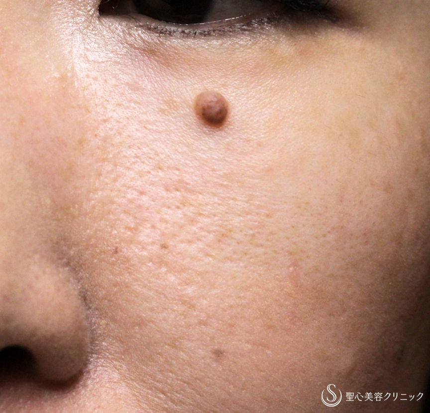 【40代女性・目まわりのホクロを取る】電気凝固法（15年後） Before 