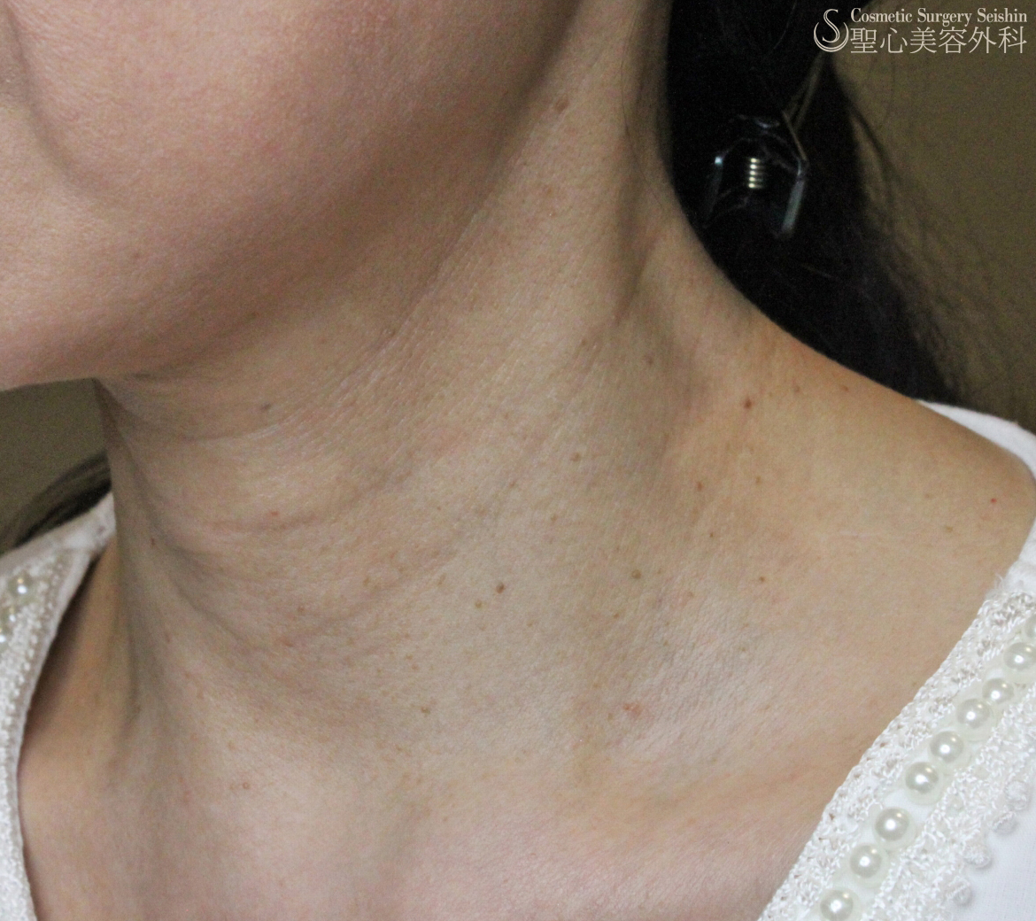 【50代女性・首の横ジワの長期経過】プレミアムPRP皮膚再生療法（10年後） Before 