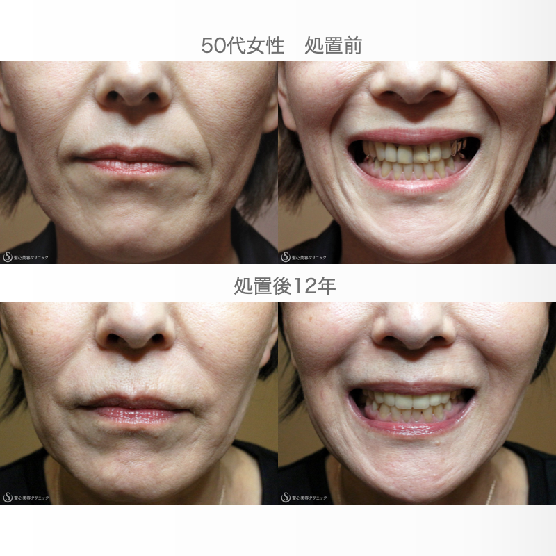 【50代女性・ホウレイ線の注入治療（長期経過）】プレミアムPRP皮膚再生療法（12年後） After 