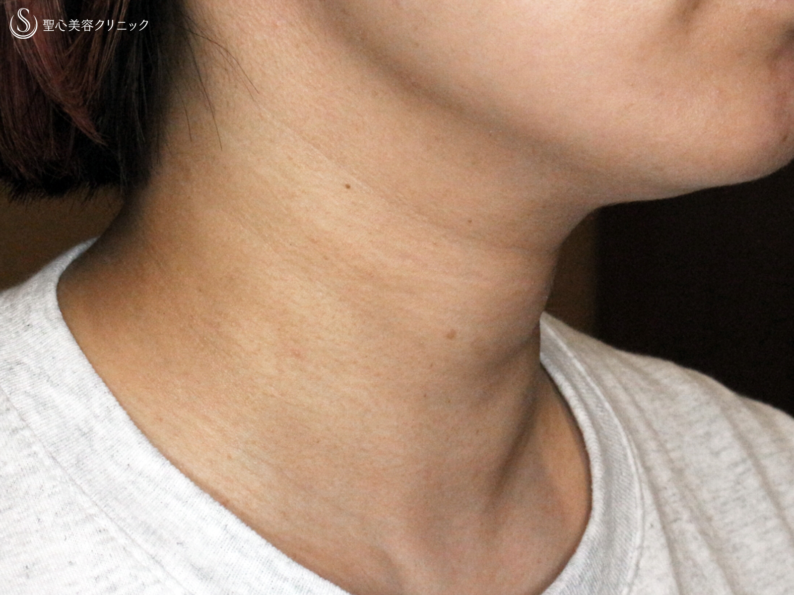 【20代女性・首の横ジワ長期経過】プレミアムPRP皮膚再生療法（処置後13年） After 