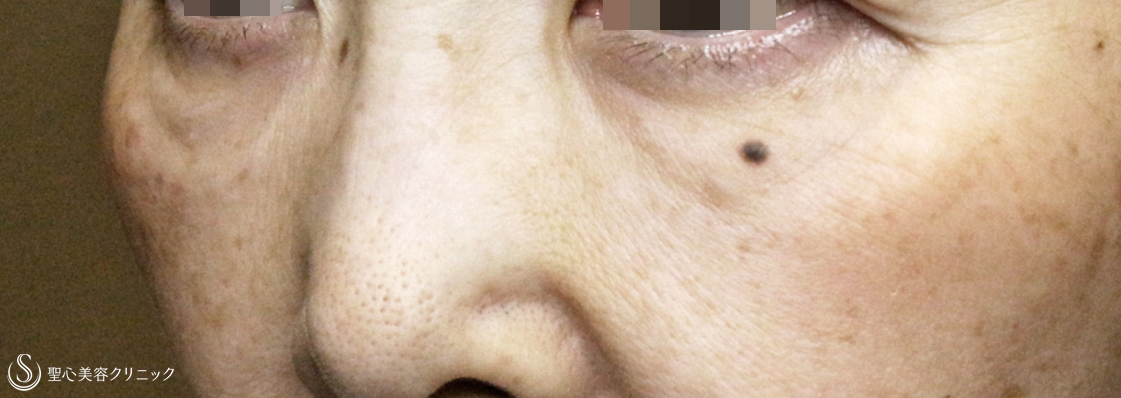 【50代女性・目の下のクマ注入単独】プレミアムPRP皮膚再生療法（6年後） After 