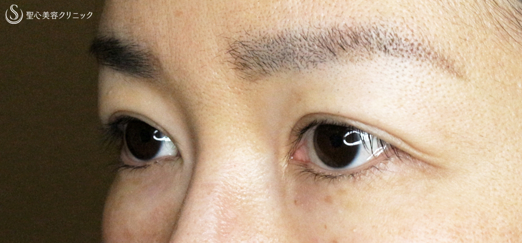 【30代女性・華やかな二重・全切開+αの第一例目】二重全切開+α法&目頭切開(7年後) 症例写真 美容整形、美容外科なら聖心美容クリニック 【30代女性・華やかな二重・全切開+αの第一例目】二重全切開+α法&目頭切開(7年後) 症例写真 美容整形、美容外科なら聖心美容クリニック