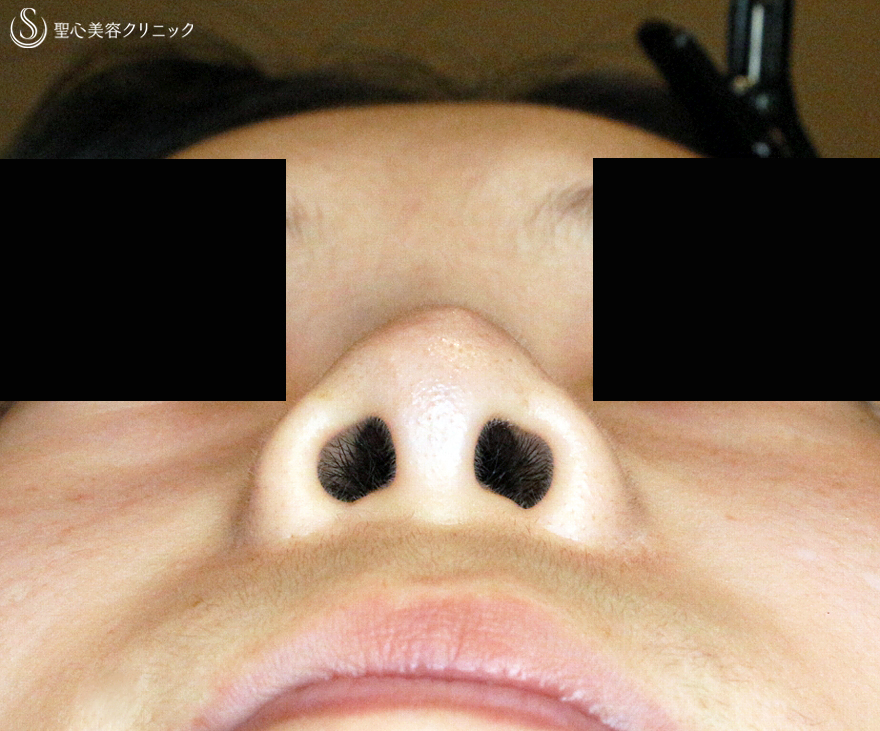 代女性 正面から鼻の穴が見える 小鼻縮小術 A法 鼻プロテーゼ 5年後 症例写真 美容整形 美容外科なら聖心美容クリニック
