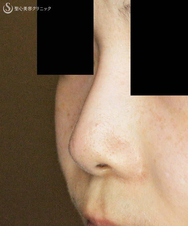 【20代女性・正面から鼻の穴が見える】小鼻縮小術+α法＆鼻プロテーゼ（5年後） After 