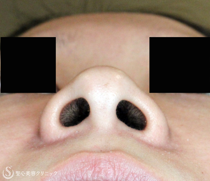 【20代女性・「忘れ鼻」に小鼻を小さく（長期経過）】小鼻縮小術+α法（6年後） Before 