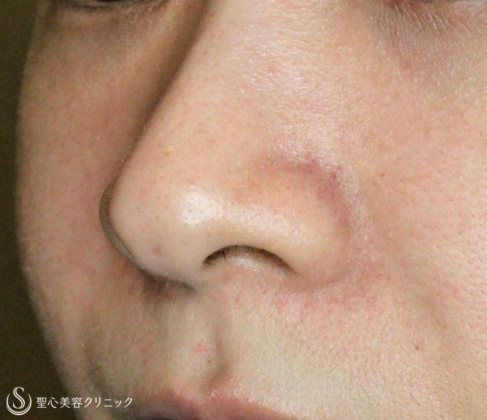 【20代女性・「忘れ鼻」に小鼻を小さく（長期経過）】小鼻縮小術+α法（6年後） Before 