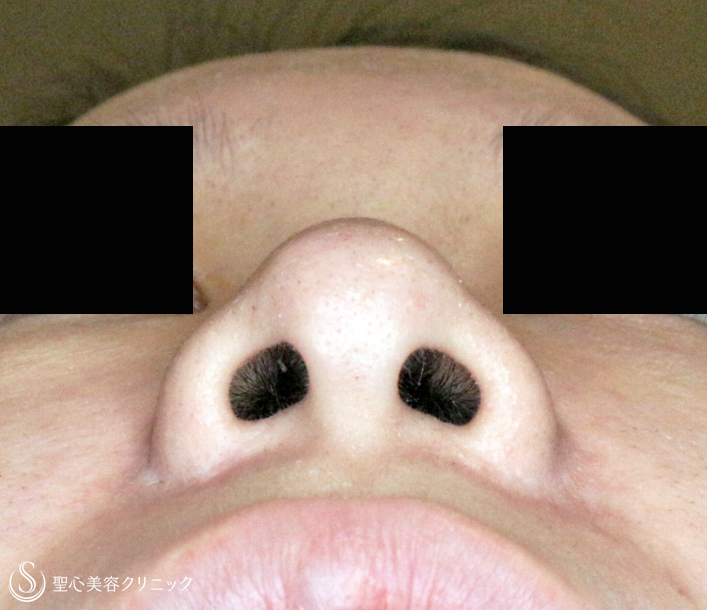 【20代女性・「忘れ鼻」に小鼻を小さく（長期経過）】小鼻縮小術+α法（6年後） After 