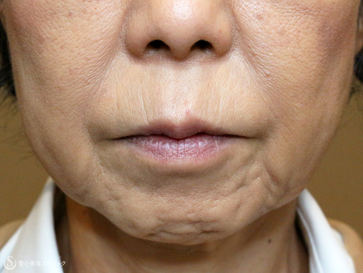 【50代女性・深いほうれい線】プレミアムPRP皮膚再生療法（3年6ヶ月後） After 