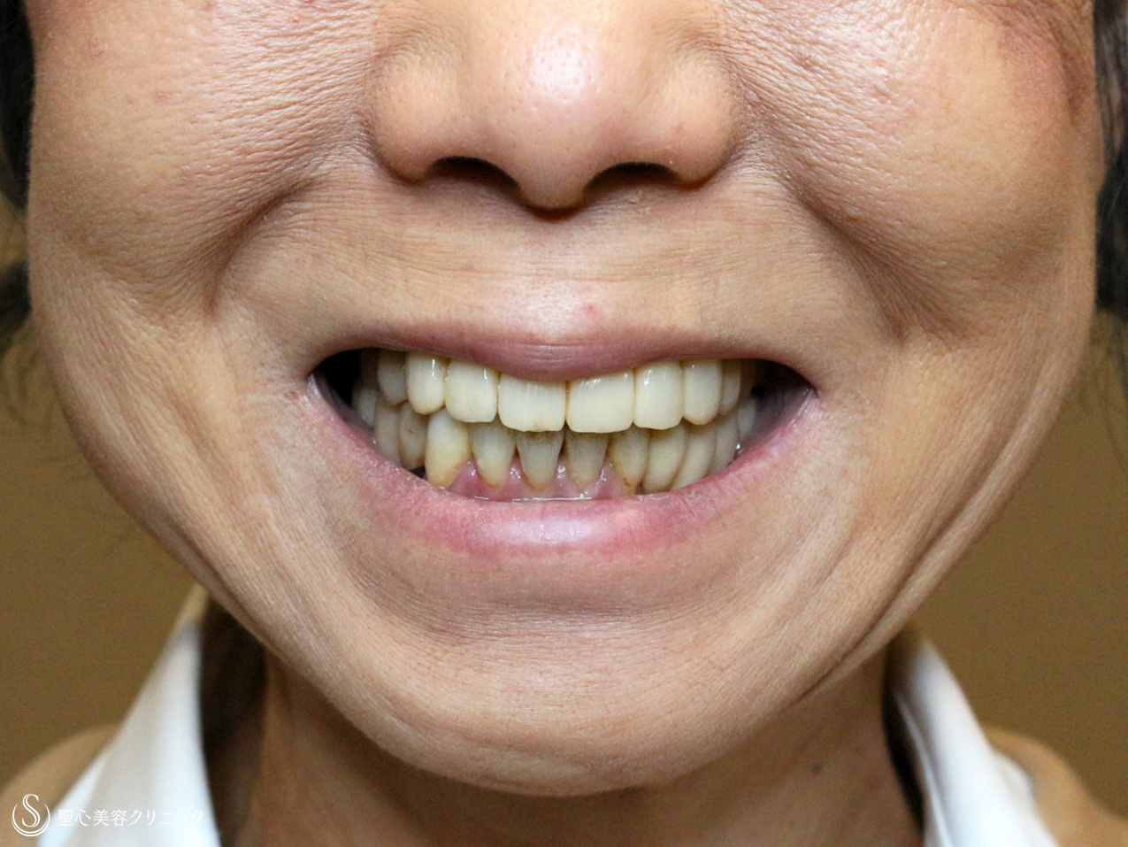 【50代女性・深いほうれい線】プレミアムPRP皮膚再生療法（3年6ヶ月後） After 