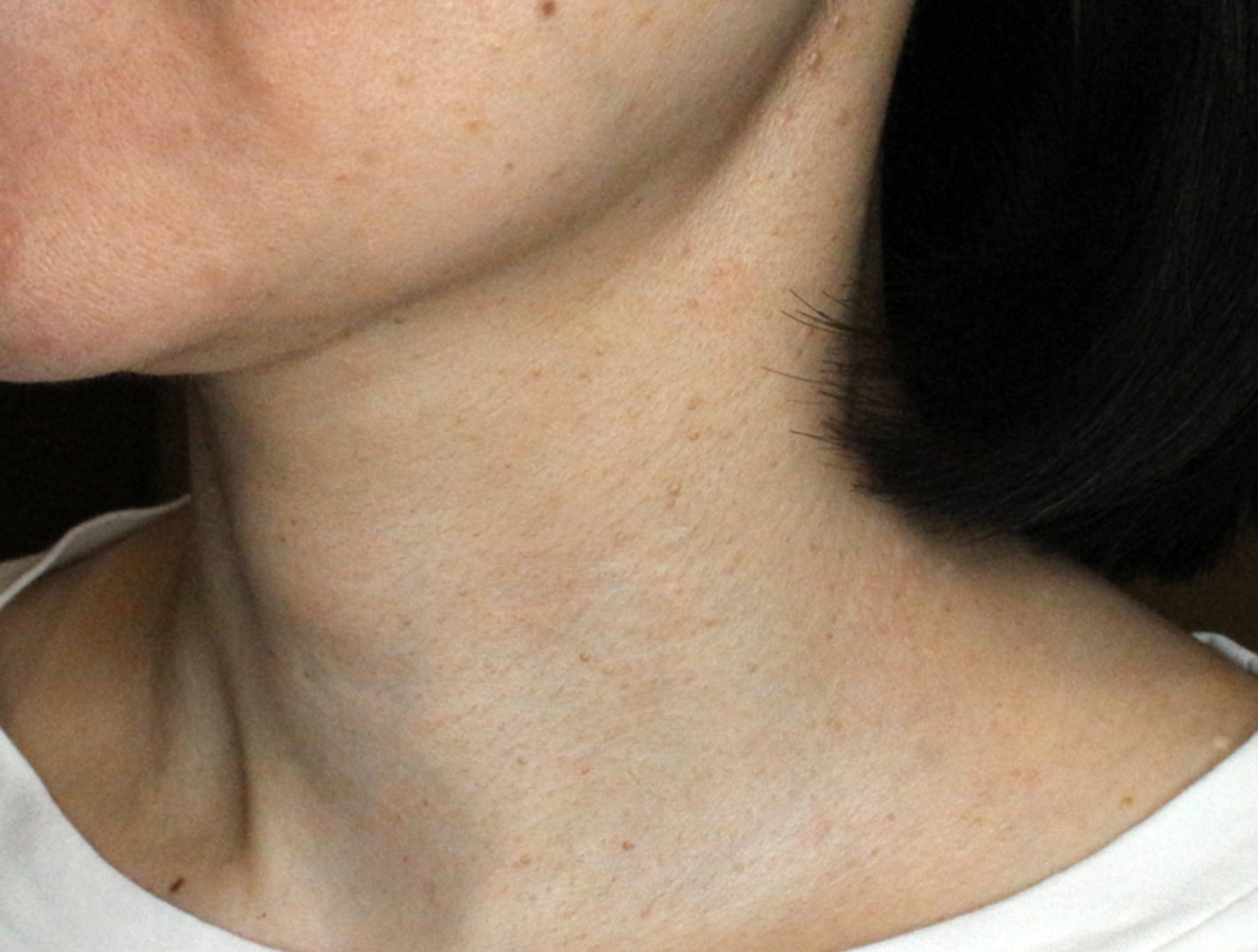 【40代女性・首の横ジワ】プレミアムPRP皮膚再生療法（5年9ヶ月後） After 