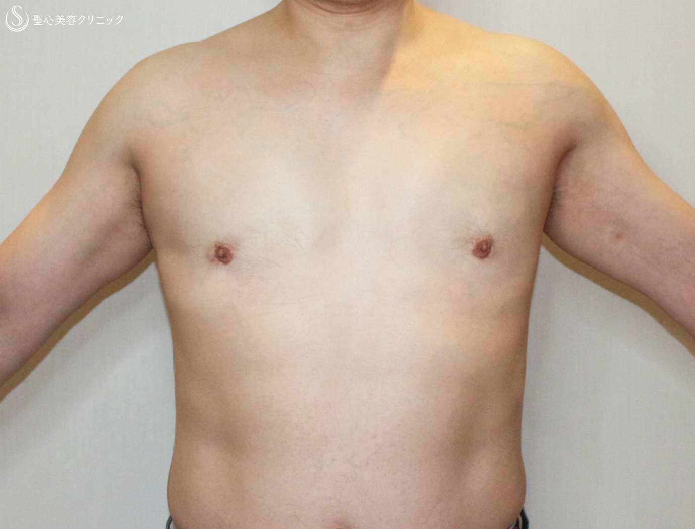 脂肪医生韩炜：男性乳房肥大，吸脂后会留疤吗？ - 知乎
