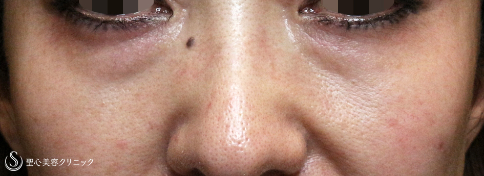 【40代女性・目の下のクマ＆たるみ】経結膜下脱脂術+プレミアムPRP皮膚再生療法（6年後） Before 
