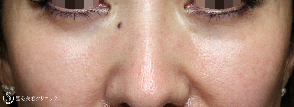 【40代女性・目の下のクマ＆たるみ】経結膜下脱脂術+プレミアムPRP皮膚再生療法（6年後） After 