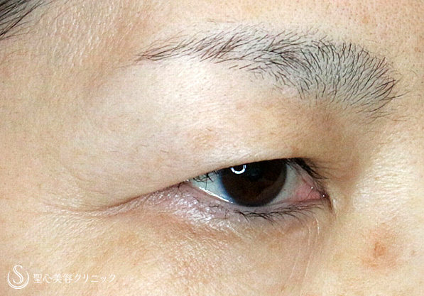 【50代女性・まぶたのタルミを取り昔の目元に戻す】2回目の眉下リフト（3年後） Before 