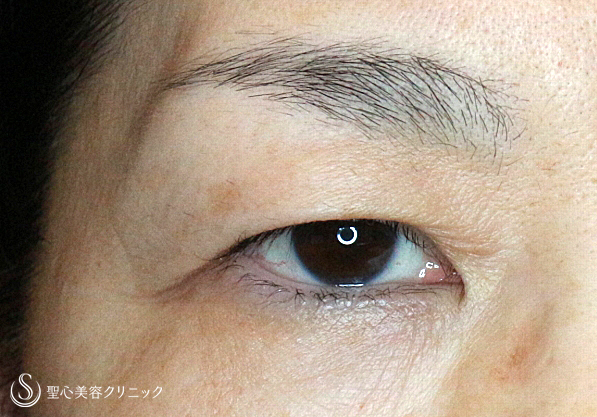 【50代女性・まぶたのタルミを取り昔の目元に戻す】2回目の眉下リフト（3年後） Before 