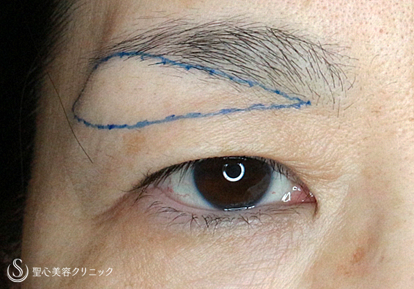 【50代女性・まぶたのタルミを取り昔の目元に戻す】2回目の眉下リフト（3年後） Before 