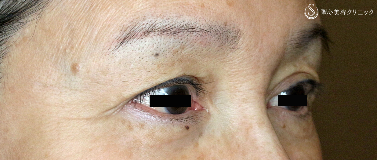 【60代女性・上まぶたのタルミ】眉下リフト単独例（9年後） Before 
