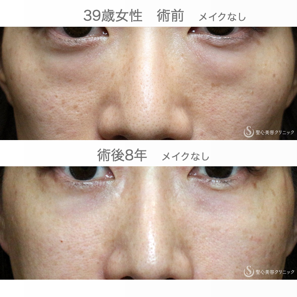 【39歳女性・目の下のクマ治療の長期経過】経結膜下脱脂術+プレミアムPRP皮膚再生療法（8年後） After 