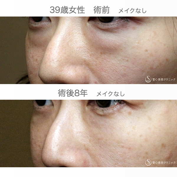 【39歳女性・目の下のクマ治療の長期経過】経結膜下脱脂術+プレミアムPRP皮膚再生療法（8年後） After 