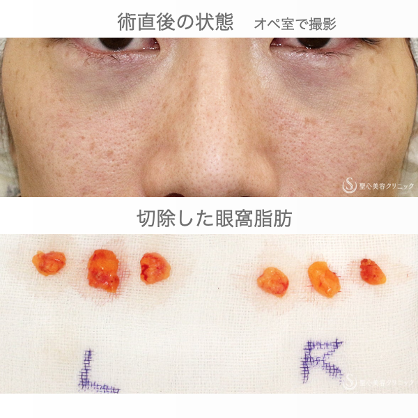 【39歳女性・目の下のクマ治療の長期経過】経結膜下脱脂術+プレミアムPRP皮膚再生療法（8年後） Before 