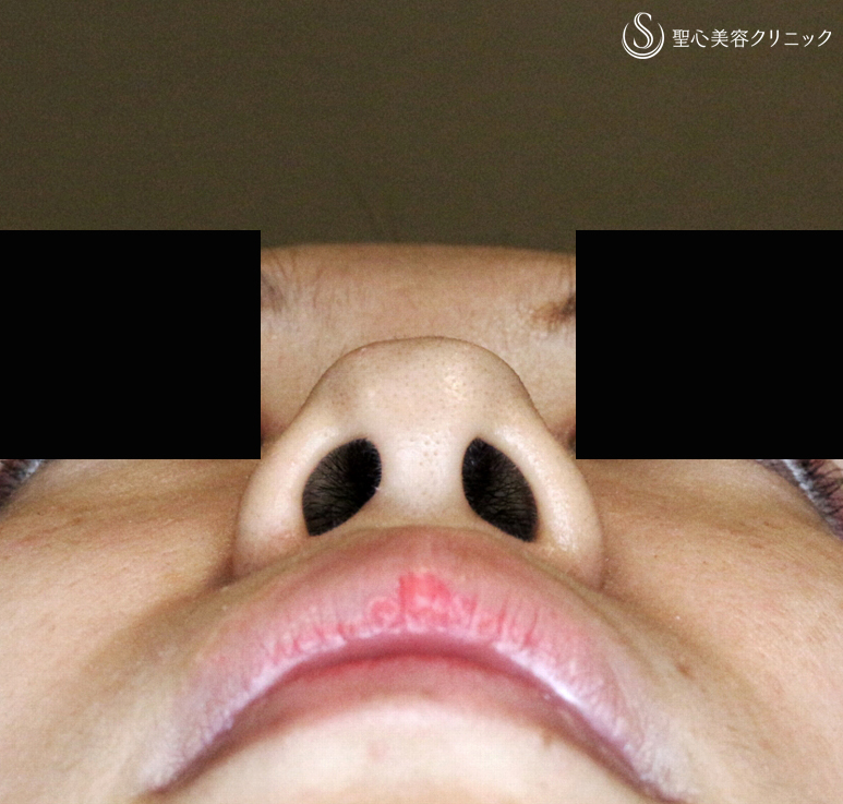 【20代女性・耳介軟骨いらずの団子鼻の治療】鼻尖縮小術+α法（5年5ヶ月後） Before 
