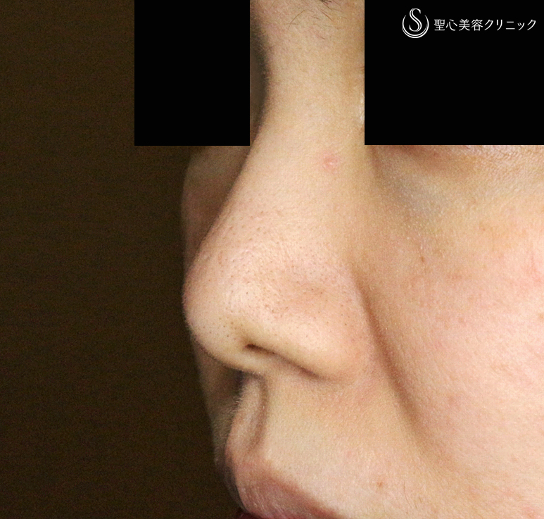 【20代女性・耳介軟骨いらずの団子鼻の治療】鼻尖縮小術+α法（5年5ヶ月後） After 