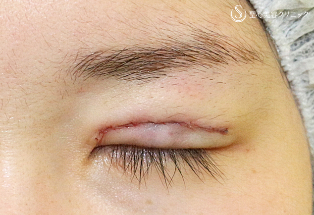 【20代女性・他院で2回眼瞼下垂術後の修正】二重全切開+α法「Ver.3」（6年8ヶ月後） Before 