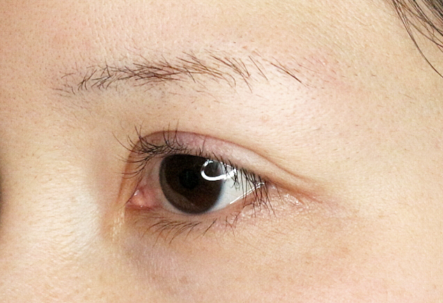 【20代女性・他院で2回眼瞼下垂術後の修正】二重全切開+α法「Ver.3」（6年8ヶ月後） After 